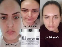 לפני ואחרי 20 יום טיפול עם קרם פיגמנטציה של KONAD